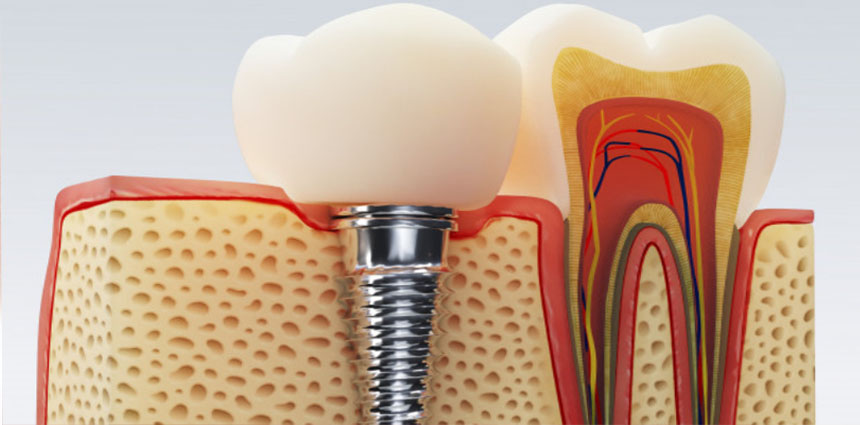 tooth implant treatment in ahmedabad