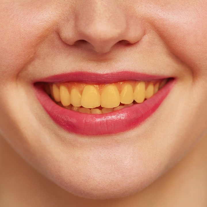 Teeth whitening in ahmedabad