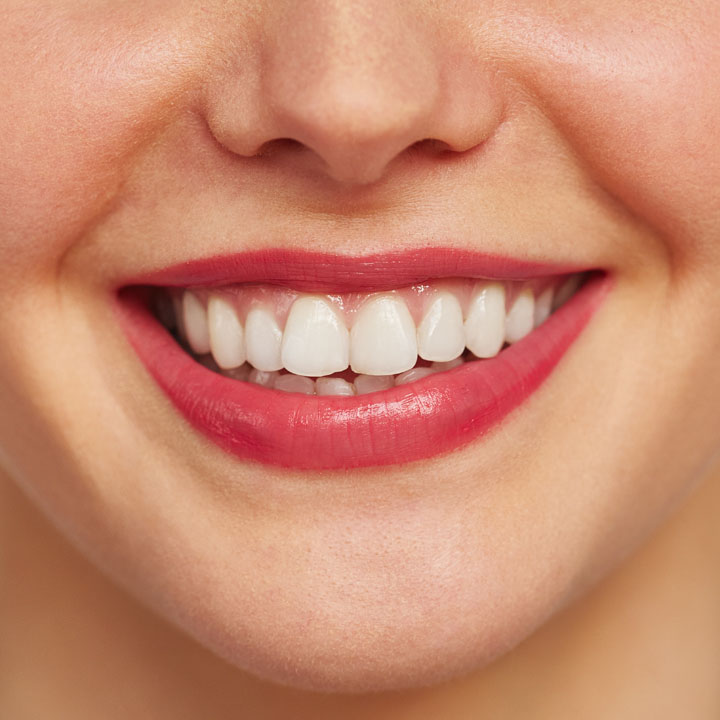 Dental Tooth Filling In Ahmedabad