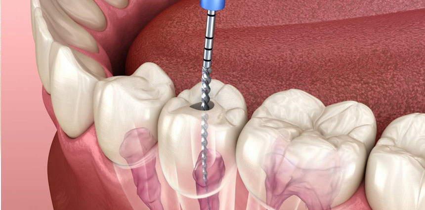 teeth cleaning in ahmedabad