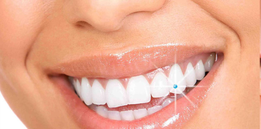 teeth cleaning in ahmedabad