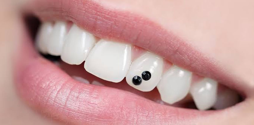 tooth implant treatment in ahmedabad