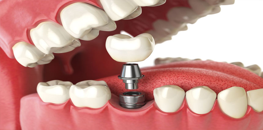 Sensitive Teeth Treatment in Ahmedabad