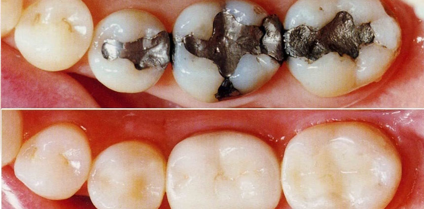 Denture Cost in ahmedabad